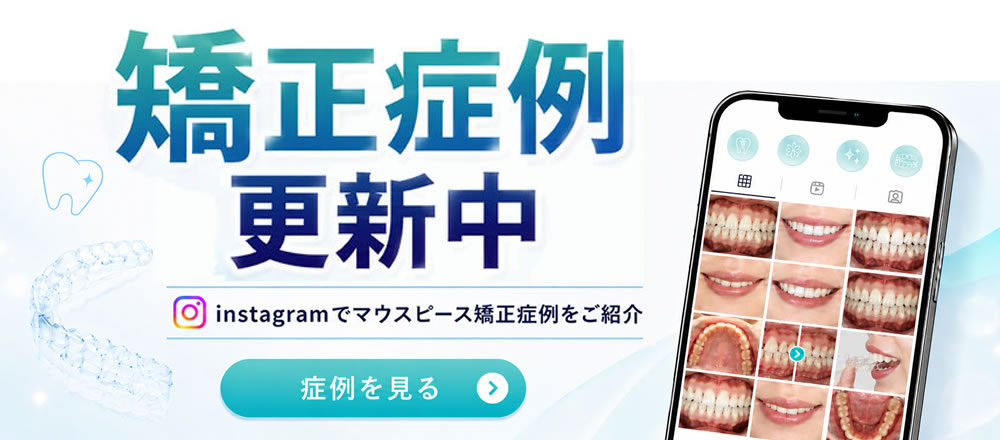 マウスピース矯正症例