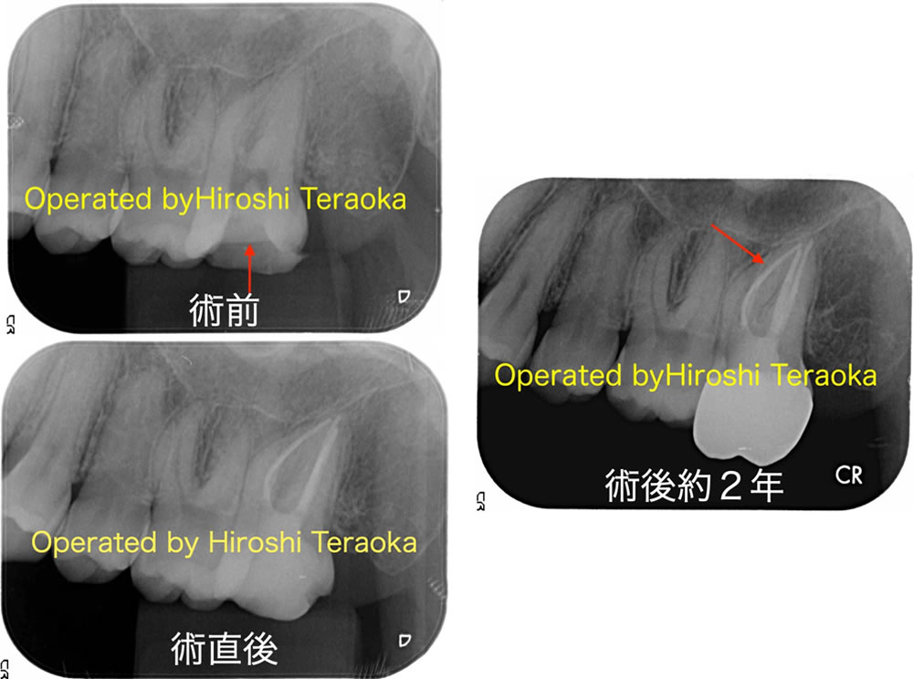 根管治療(通常)の症例