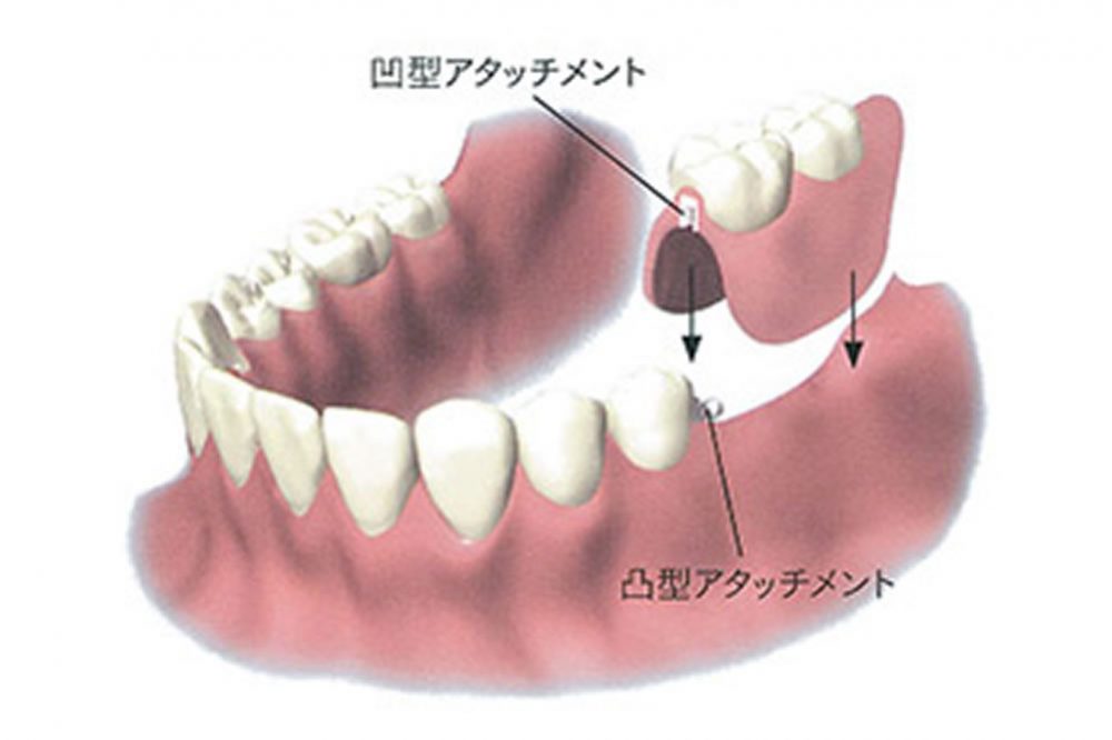 アタッチメント