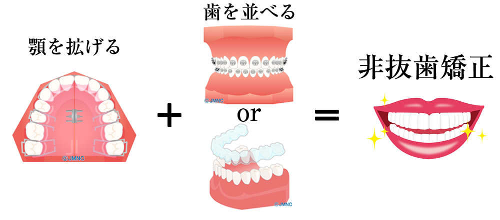 コンビネーション非抜歯矯正